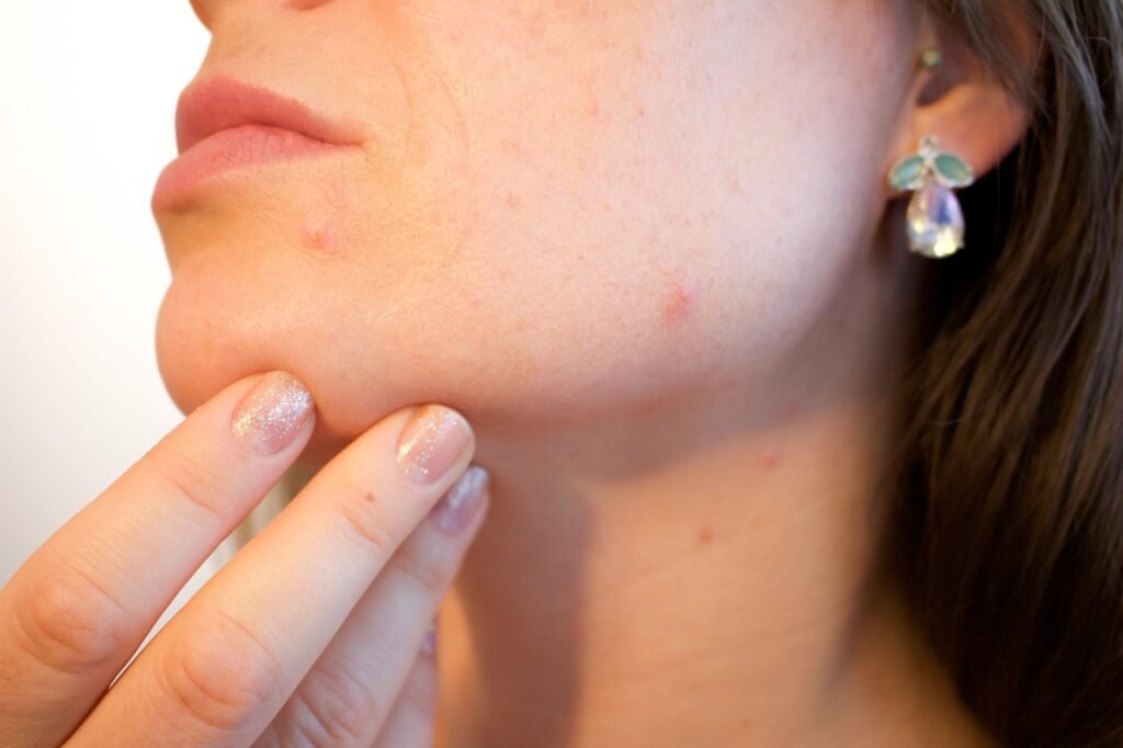 Solutions for Women’s Acne Problems